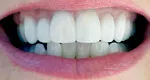after porcelain veneers