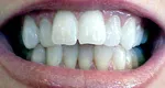 Before porcelain veneers